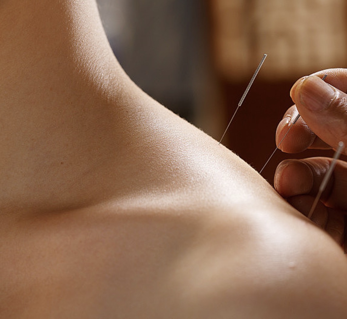 ACUPUNCTURE